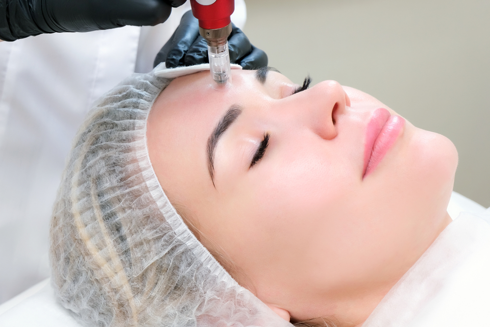 Microneedling Services in Gurnee, IL